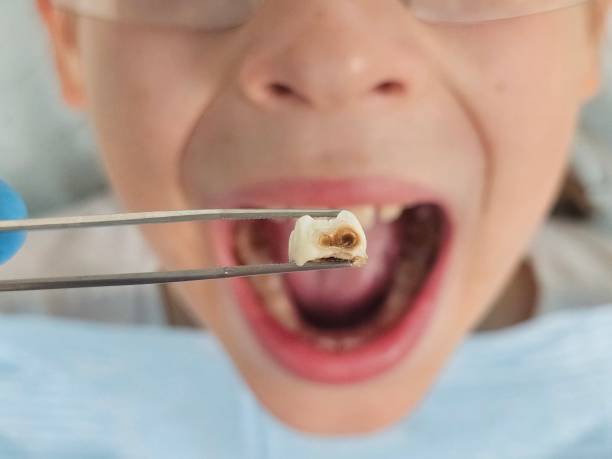 Best Pediatric Emergency Dentist in Coushatta, LA